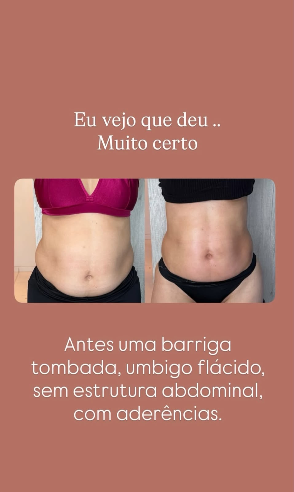 Di&aacute;stase Abdominal 3